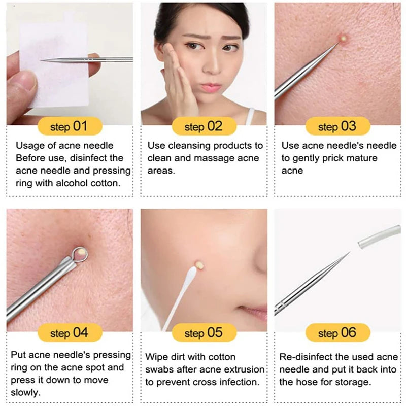 4Pcs Blackhead and Acne Remover Set step-by-step facial application diagram for safe pimple extraction without scarring
