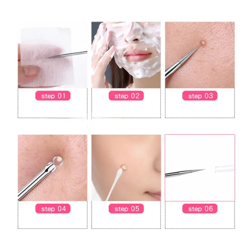 Stainless Steel Blackhead Remover Tool – Acne Pore Extractor Needle Secondary image