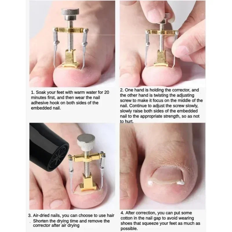 Ingrown Toenail Corrector Clip Onyxis Care