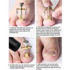 Ingrown Toenail Corrector Clip Onyxis Care