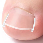Ingrown Toenail Correction Tool Foot Care