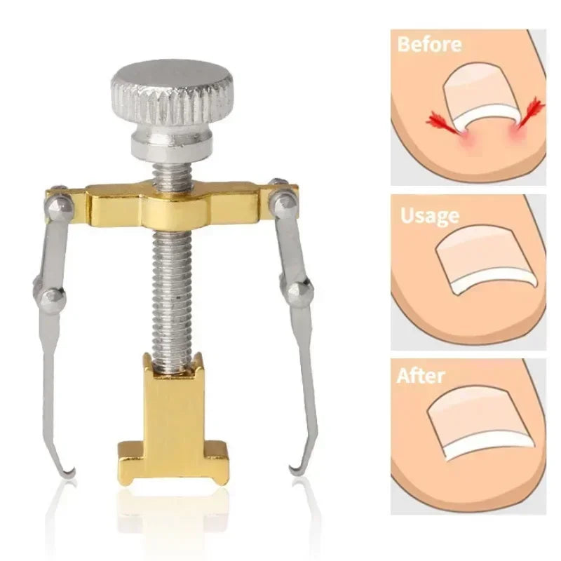 Ingrown Toenail Corrector Clip Onyxis Care