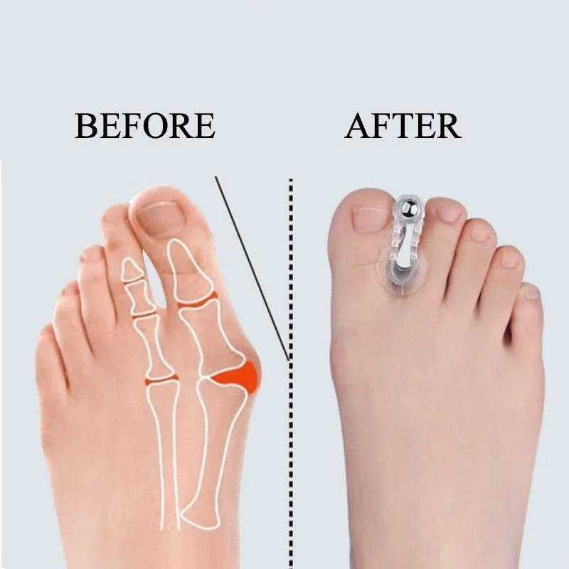 Bunion Corrector Toe Separator Support