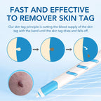 Skin Tag Remover 1-4mm Painless Safe Home Use Face Skin Care