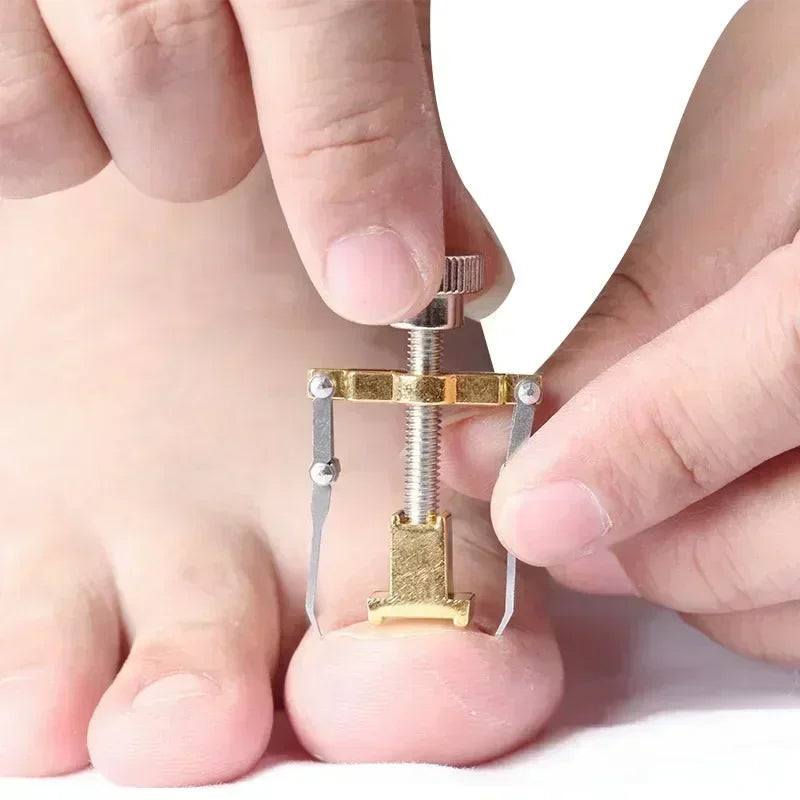 Ingrown Toenail Corrector Clip Onyxis Care