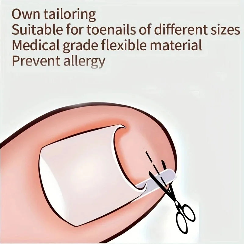 Ingrown Toenail Correction Tool Foot Care