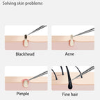 Stainless Steel Acne Blackhead Removal Needle – Pimple Extractor Tool