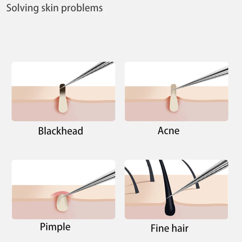 Stainless Steel Acne Blackhead Removal Needle – Pimple Extractor Tool