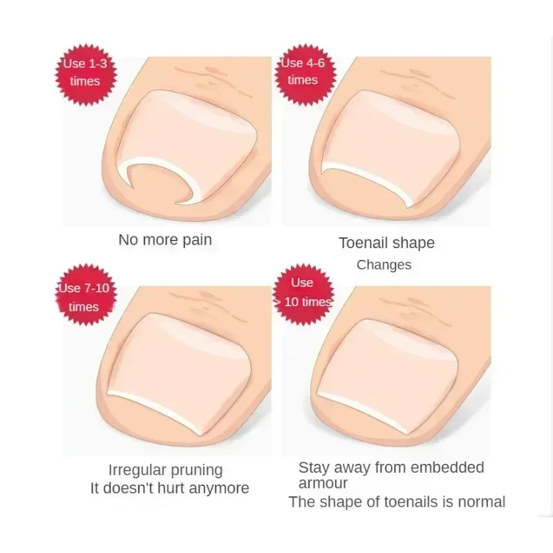 Ingrown Toenail Corrector Clip Onyxis Care