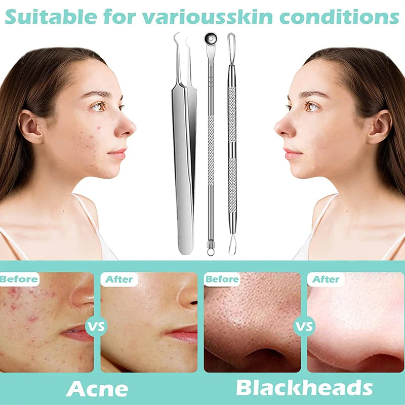 Stainless Steel Acne Blackhead Removal Needle – Pimple Extractor Tool Secondary image