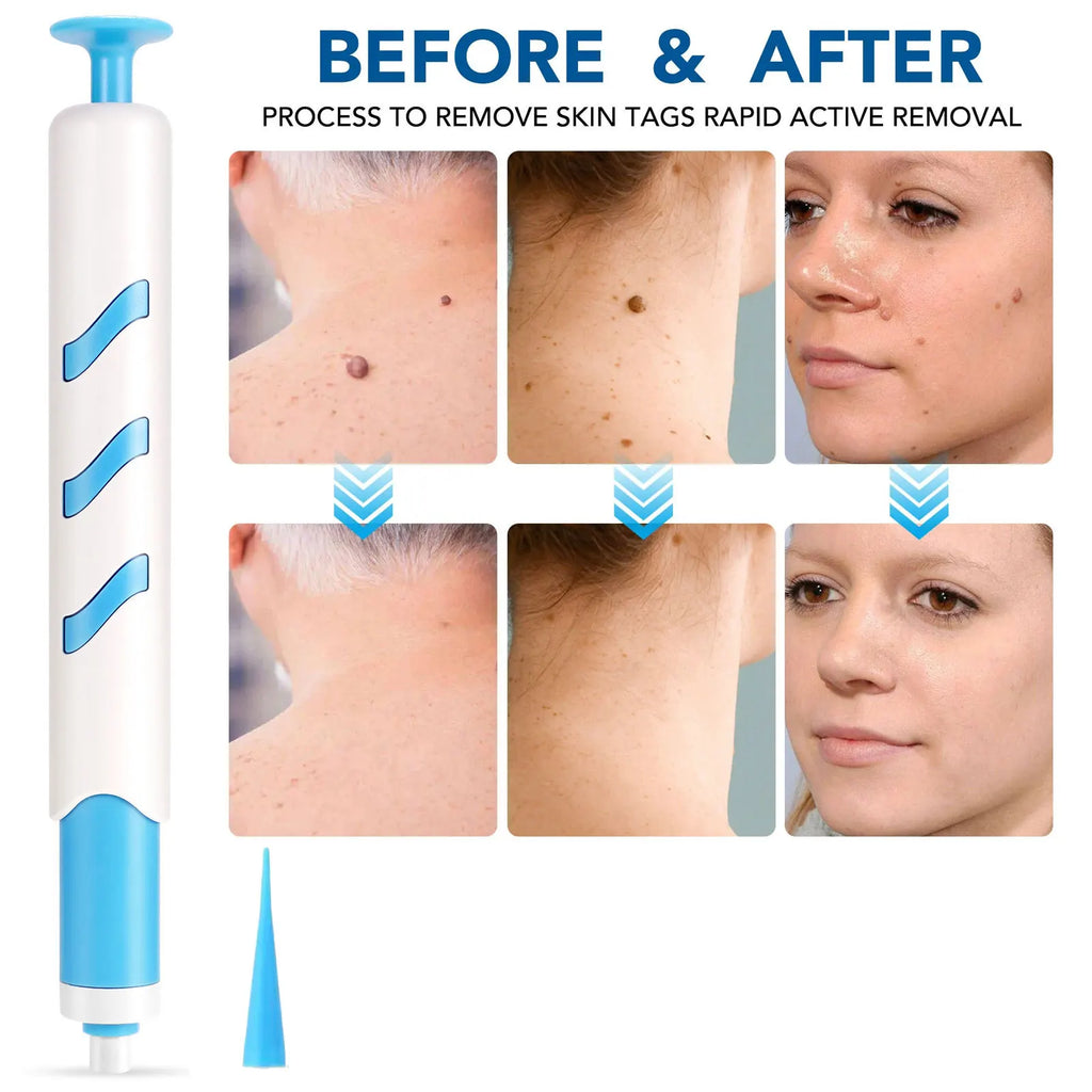 Skin Tag Remover 1-4mm Painless Safe Home Use Face Skin Care