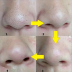 Blackhead Nose Strips before and after skin comparison for removing stubborn blackheads and dirt