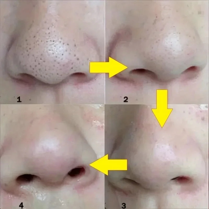 Blackhead Nose Strips before and after skin comparison for removing stubborn blackheads and dirt
