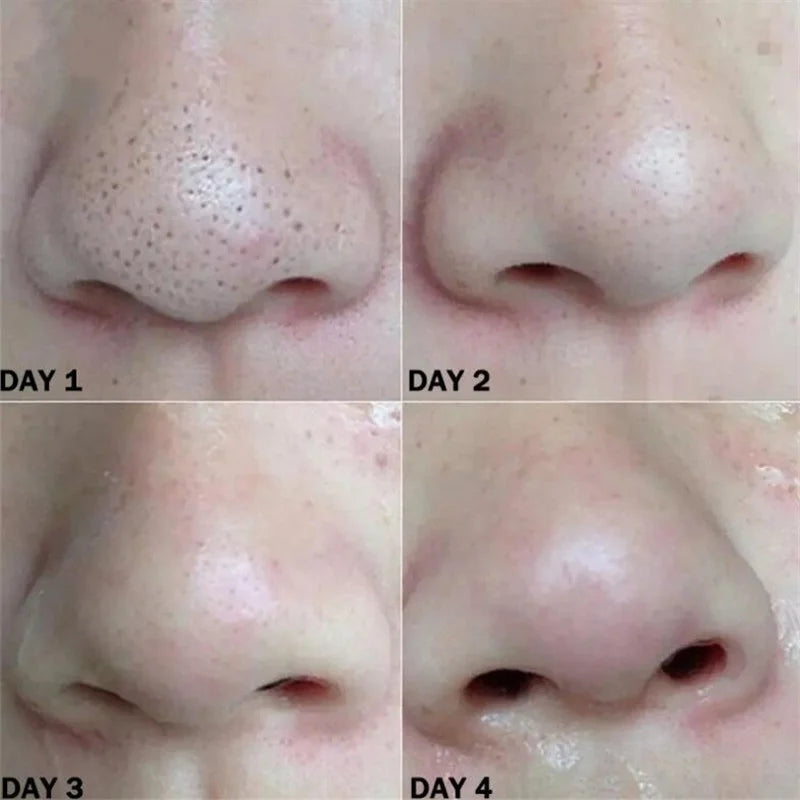 Nose Blackhead Remover Mask Nasal Strips before and after nose comparison for visibly shrunk pores and clear skin